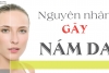 NGUYÊN NHÂN GÂY NÁM DA VÀ CÁCH ĐIỀU TRỊ